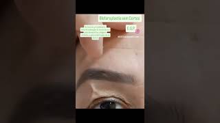 Blefaroplastia sem Cortes!!Jato de Plasma! recuperação de seu colágeno e elastina 🚀 #jatodeplasma