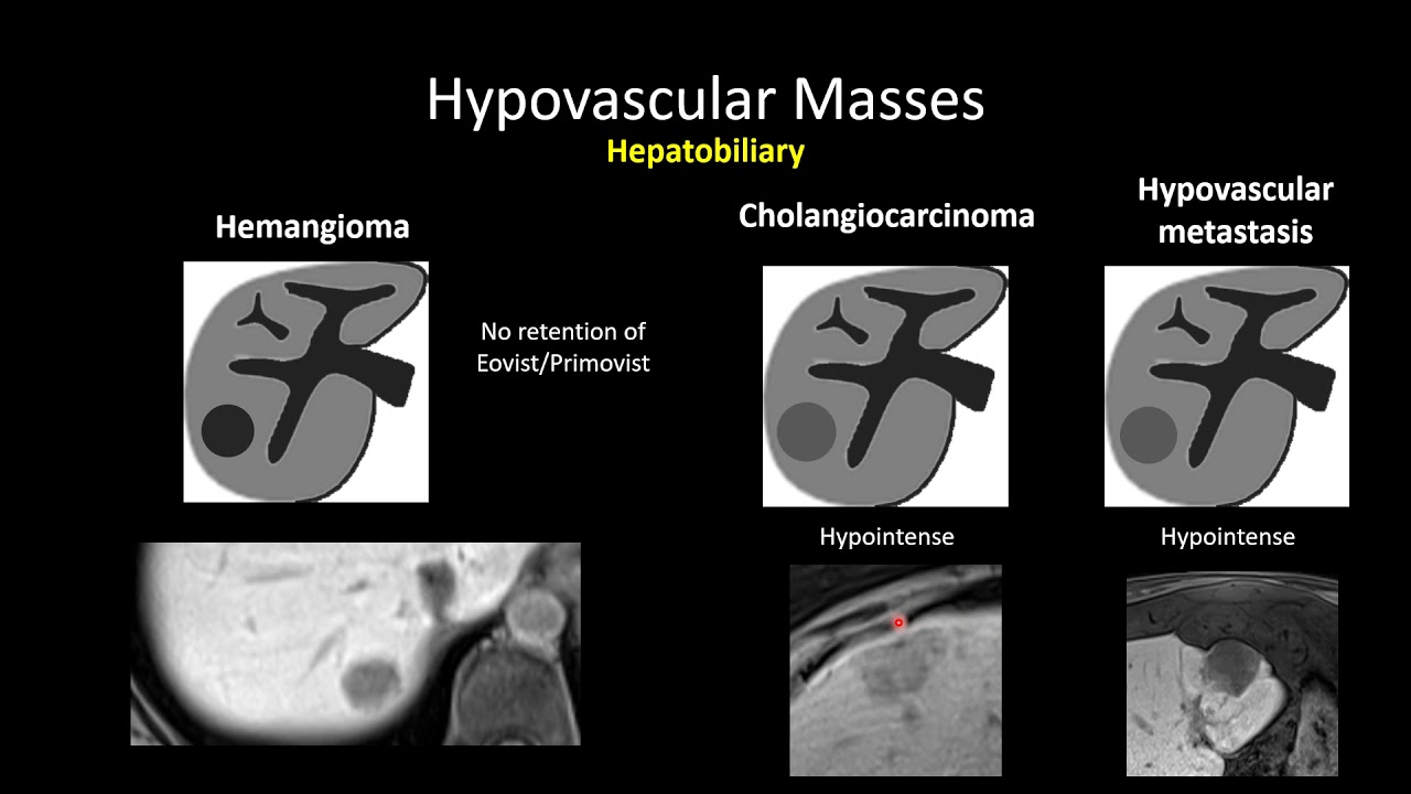 HypoVascular Masses Of The Liver YouTube