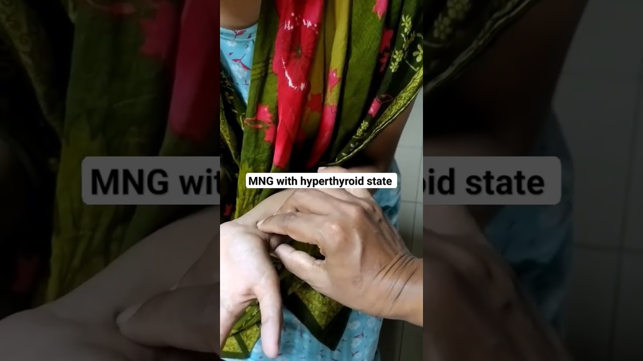 Multinodular goitre with hyperthyroidism