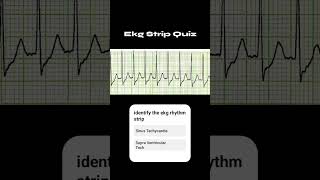 EKG Quiz Time! ⚡ Can you identify this rhythm?