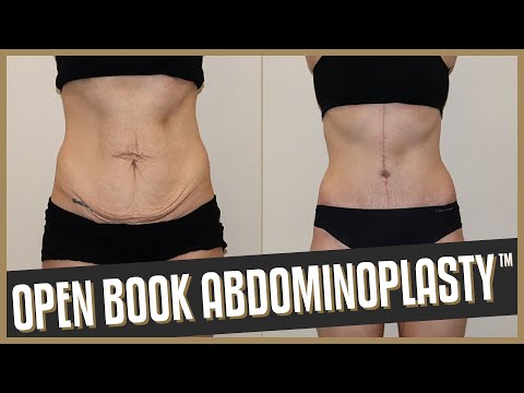 Open Book Tummy Tuck™ (Abdominoplasty)