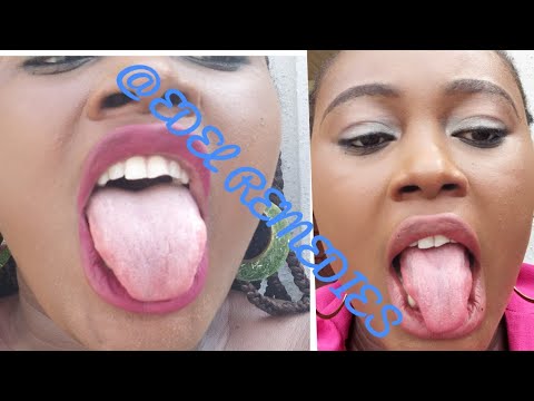 How To Get Rid Of White On Tongue