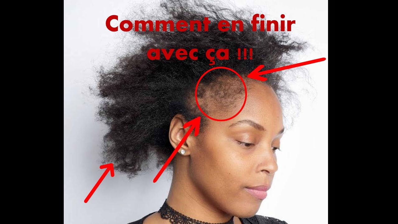 📢🚩J'ai des cheveux fins et une alopécie partielle comment en prendre soin ?!!