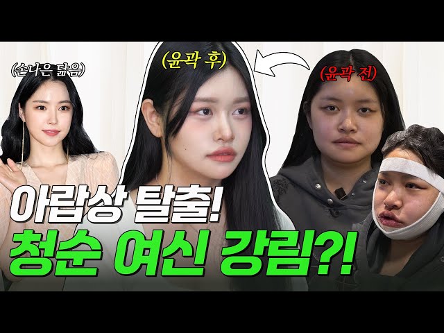 [성형브이로그] 🥰👉태연이의 안면윤곽 3종 8개월차👈💕