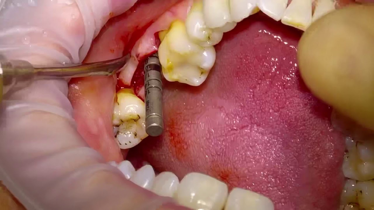 Using a Drill Guide for dental implant placement YouTube