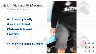 Arthroscopically Assisted Tibial Plateau Internal Fixation - 11 months post surgery