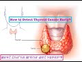How to Detect Thyroid Cancer Early? ꯀꯔꯝꯅꯥ ꯊꯥꯏꯔꯣꯏꯗ ꯀꯦꯟꯁꯔ ꯉꯟꯅꯥ ꯈꯡꯒꯗꯒꯦ?