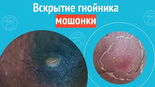 👨‍⚕️ Вскрытие гнойника мошонки. Клинический случай №1292