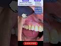 Ш Ш Ш Ш Ш Щ ШЈШіЩ Ш Щ Ш Щ ШЈЩ Ш Щ ЩЉШ ШЁШЇЩ Щ ШЈЩ Щ рџ Dental Abcess Viral Shorts Ш Ш Ш Ш Ш Щ ШЈШіЩ Ш Щ Ш Щ ШЈЩ Ш Щ ЩЉШ ШЁШЇЩ Щ ШЈЩ Щ рџ Dental Abcess Viral Shorts