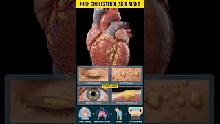 High cholesterol can leave visible skin signs and affect heart health—know the warning signs early.