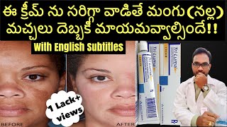 మంగు మచ్చలకి ఈ క్రీమ్ వాడితే మిల మిల మెరిసిపోతారు/GET RID OF MELASMA/BLACK SPOTS WITH TRILUMA CREAM!