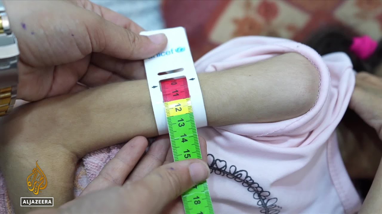 يموت الأطفال في غزة جوعاً: ببطء، وبألم، وبصمت.