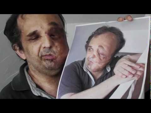 Facial tumor jose images 523