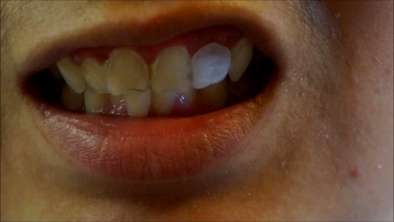 Fix a MISSING or BROKEN TOOTH AT HOME YouTube