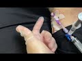 How to delcot a picc cvc central line catheter with thrombolytic enzymes alteplase cathflo turorial