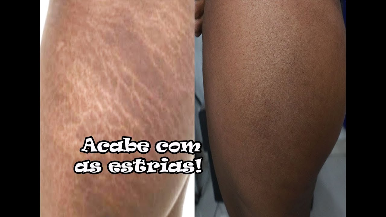 Como Eliminei Minhas Estrias com apenas 1 ingrediente de R$6,00 - YouTube