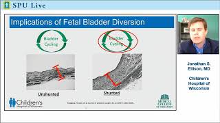 SPU Live: What is the Best Postnatal Surgical Intervention for Posterior Urethral Valves?