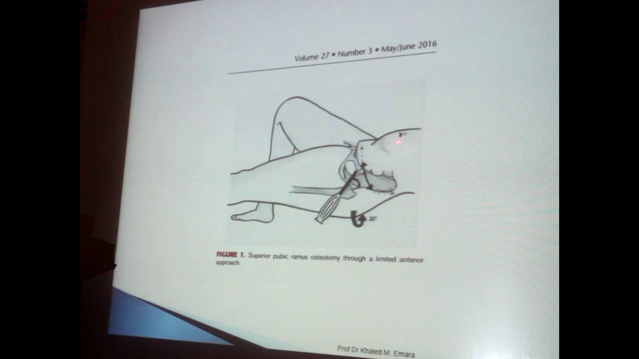 periacetabular osteotomy (Ganz) - Prof.Dr khaled emara