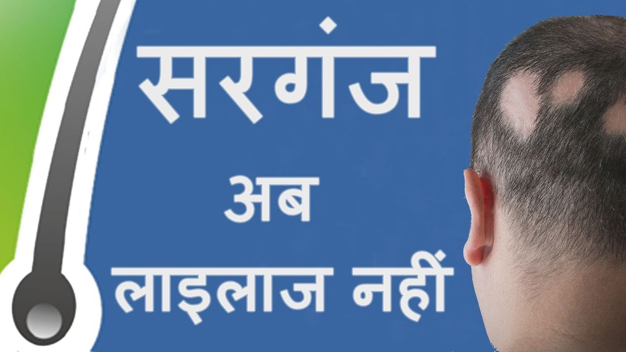 Ayurvedic Treatment of Patchy Hair Loss/Alopecia Areata । सरगंज अब