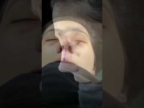 Çox geniş burun və qalın dəri