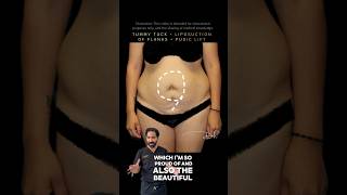 TUMMY TUCK + LIPOSUCTION OF FLANKS + PUBIC LIFT