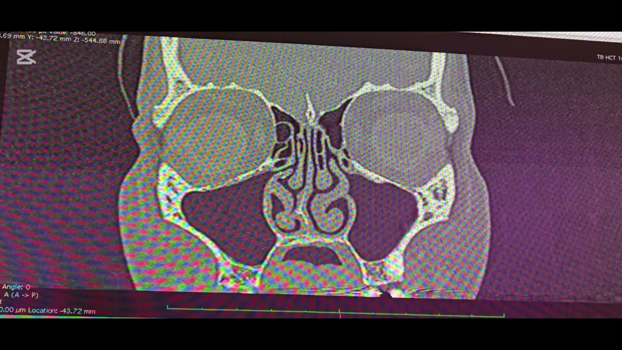 Navigation + CT PNS and Neck, ALAIGAL ,