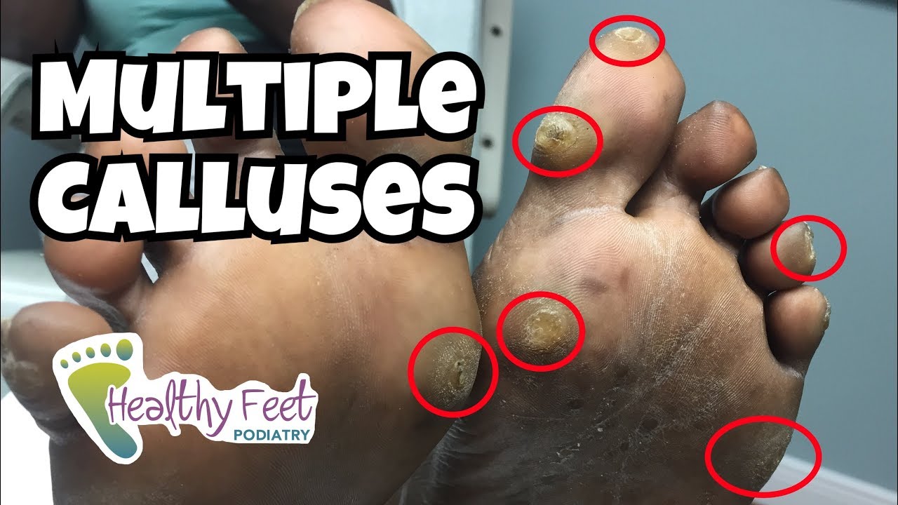 Multiple Calluses on Feet - YouTube