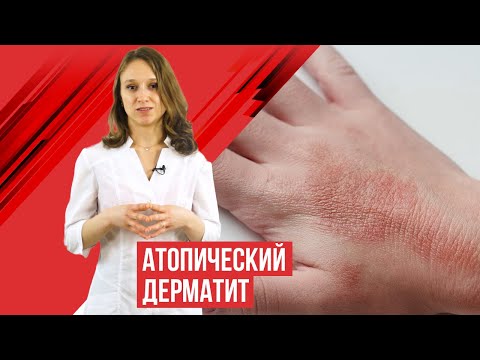 Атопический дерматит у
