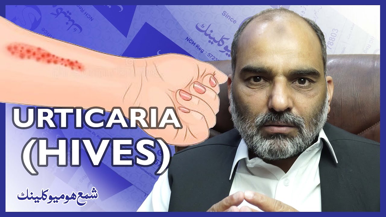 Urticaria (HIVES) دھپڑ چھپاکی ریشز dhapar chapaki rashes by Dr