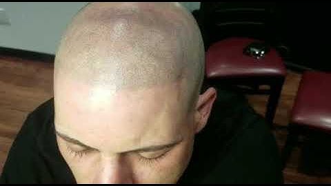 Up close Results Hairloss ScalpMicropigmentation