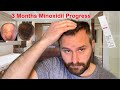 3 Months Results With Minoxidil (Generic Rogaine) - What You Can Expect