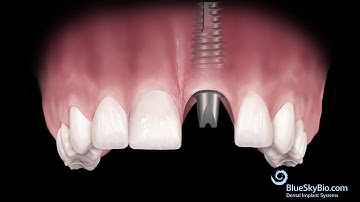 Multi Purpose Abutment Instructional Video