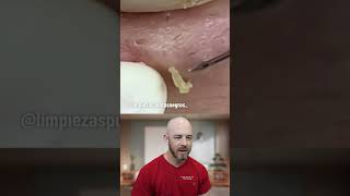 Blackheads beware… it’s pop o’clock! 💥 (credit:@limpiezaspuntosnegros_ on TT) #blackhead #fyp