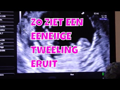 Video: Hoe Zwanger Te Raken Zodat Een Tweeling Wordt Geboren?