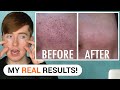 How To Get Rid of Blackheads - AMAZING BEFORE AND AFTER RESULTS