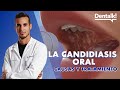 ¿HONGOS en la BOCA? Causas, prevención y tratamiento de la CANDIDIASIS oral y BOQUERAS | Dentalk! ©