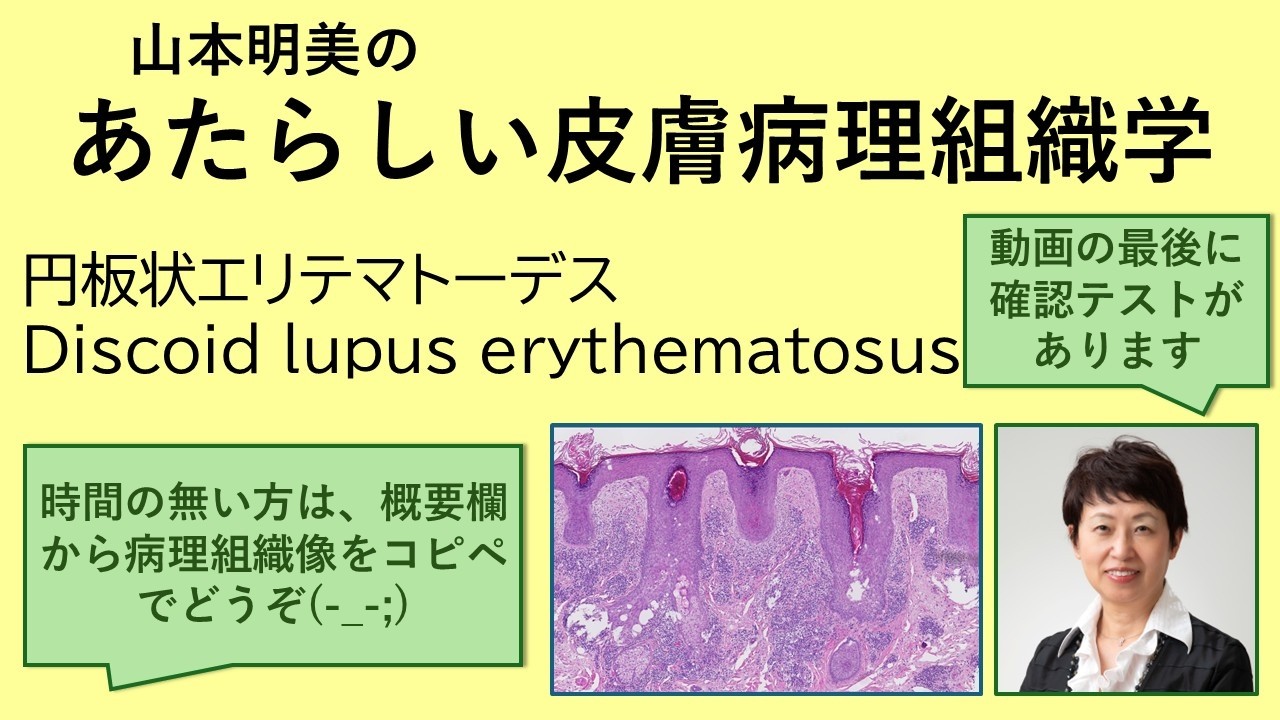 New Dermatopathology: Discoid Lupus Erythematosus - YouTube