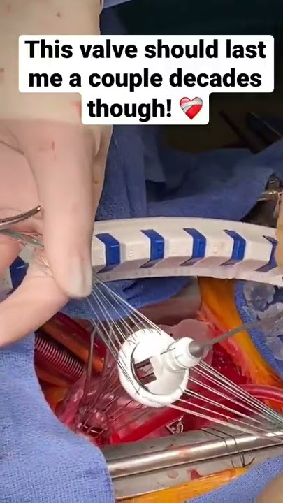 Amazing Heart Surgery Footage // Mechanical Heart Valve