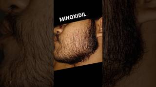 Minoxidil Evolução Barba 1 ano e 8 meses Kirkland e Foligain #minoxidil #barba #thedicas