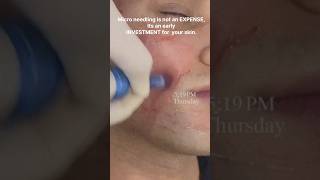 Microneedling #shortsvideo #doctor #skincareroutine #skincare #skincaretips #treatment