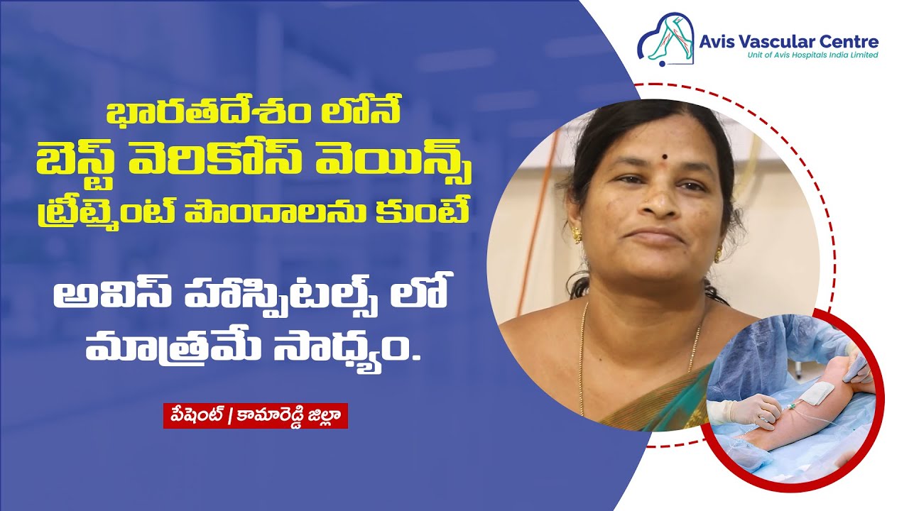 Pain-Free Varicose Veins Treatment | Patient Testimonial | Avis Hospitals