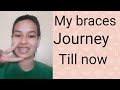 My braces journey//q n a related to braces//all about braces