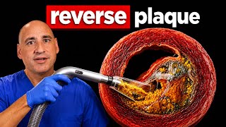 This is What Your Should Do To REVERSE PLAQUE - Dr. Philip Ovadia Guía