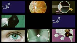 Raymond Richards - Scleral Buckle (Official)