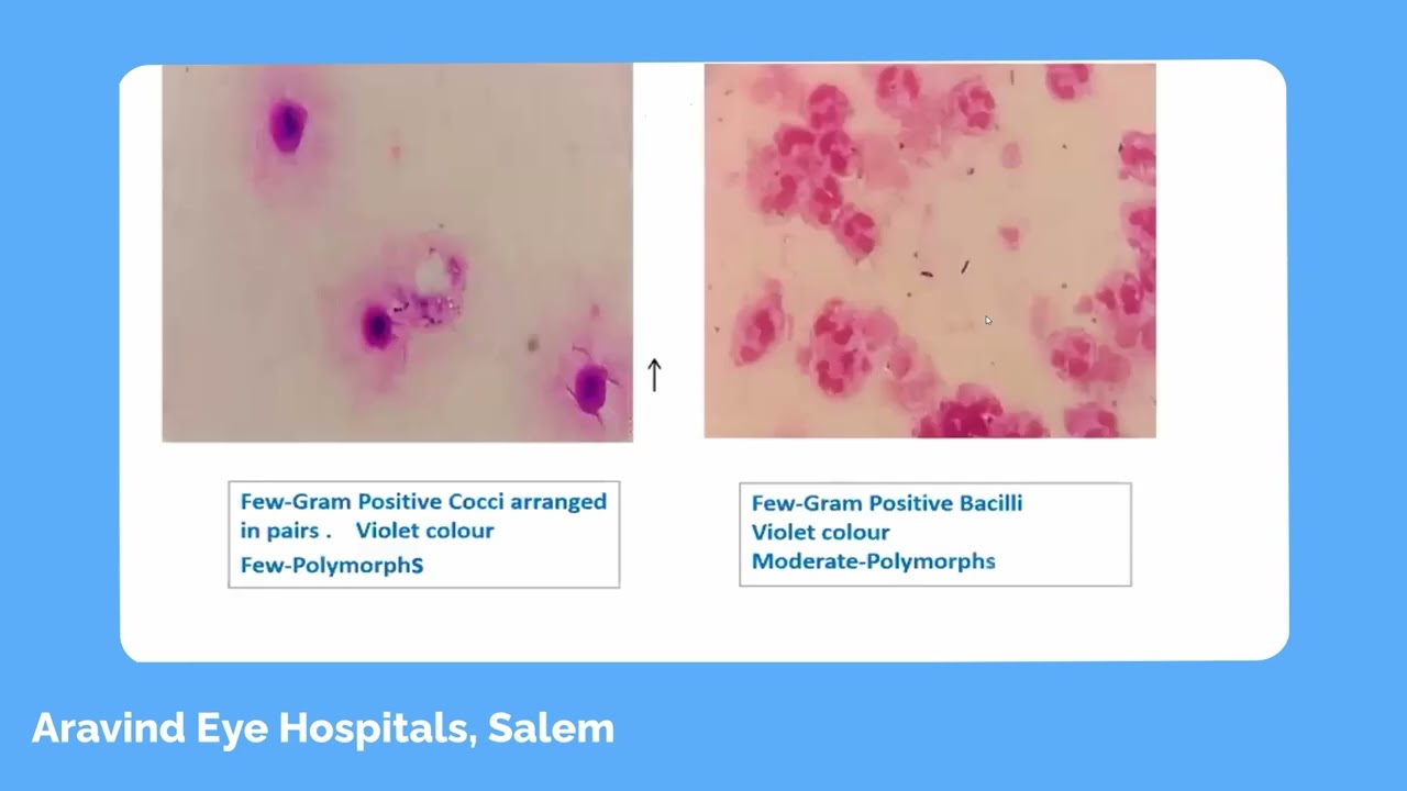 Comprehensive Approach to Diagnosing Ocular Infections | Dr. Suneetha Puneeth - AEH Salem