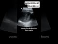 Appendiceal mucocele on ultrasound #radiology #ultrasound
