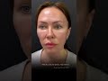 Свежее лицо после подтяжки  #фейслифтинг
