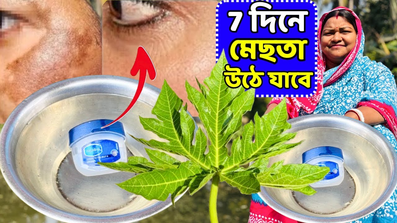 7 দিনে মেছতার কালো দাগ উঠে যাবে / Melasma Treatment​