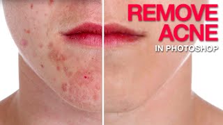 How to Remove Acne in Photoshop