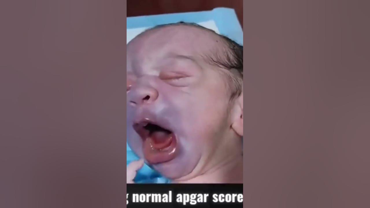 Face bruising of baby due to natural birth shorts youtube
